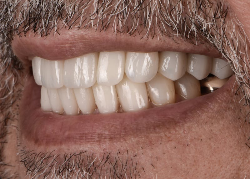 Full Mouth Restoration Before & After Gallery - Patient 241308 - Image 6