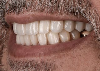 Full Mouth Restoration Before & After Gallery - Patient 241308 - Image 6