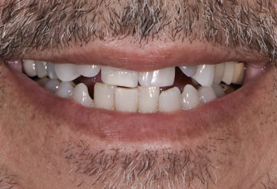 Full Mouth Restoration Before & After Gallery - Patient 241308 - Image 1