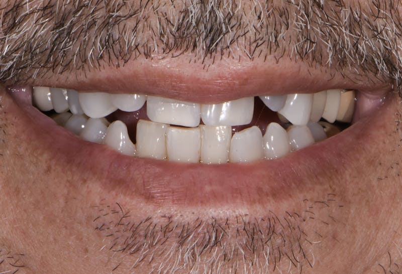 Full Mouth Restoration Before & After Gallery - Patient 241308 - Image 1