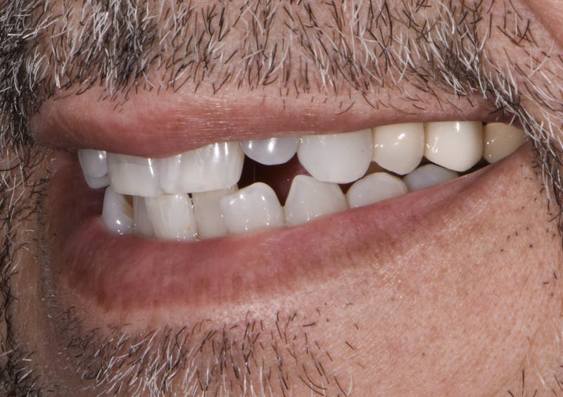 Full Mouth Restoration Before & After Gallery - Patient 241308 - Image 5