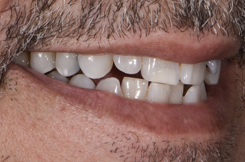 Full Mouth Restoration Before & After Gallery - Patient 241308 - Image 3
