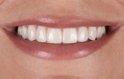 Porcelain Veneers Before & After Gallery - Patient 669938 - Image 2