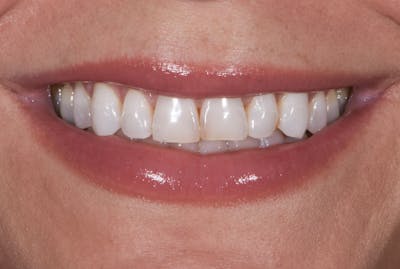 Porcelain Veneers Before & After Gallery - Patient 669938 - Image 1