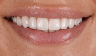 Prep-less Veneers Before & After Gallery - Patient 250395 - Image 2