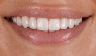 Prep-less Veneers Before & After Gallery - Patient 250395 - Image 2