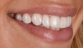 Prep-less Veneers Before & After Gallery - Patient 250395 - Image 4