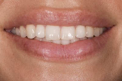 Prep-less Veneers Before & After Gallery - Patient 250395 - Image 1