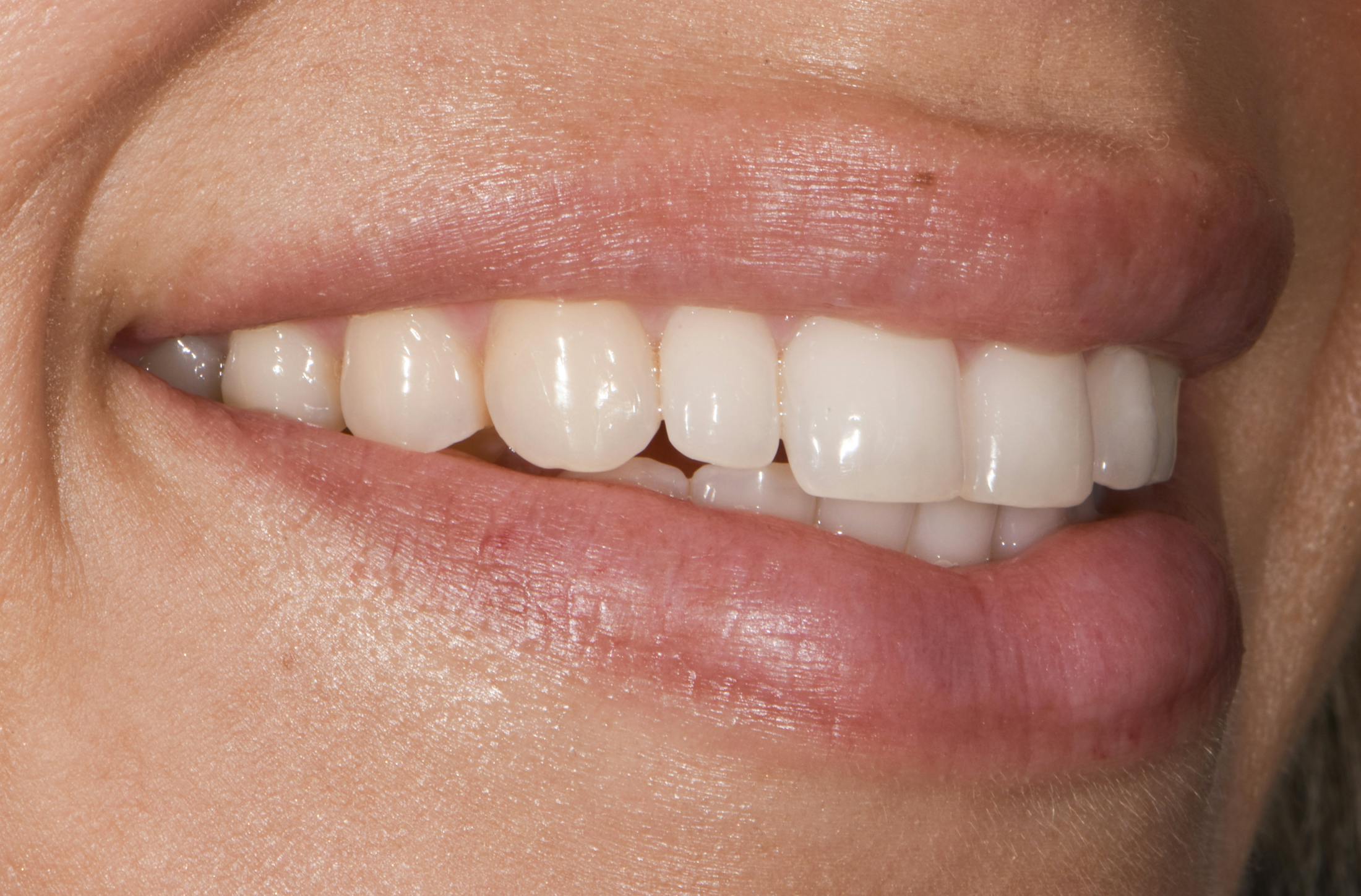 Prep-less Veneers Before & After Gallery - Patient 250395 - Image 3