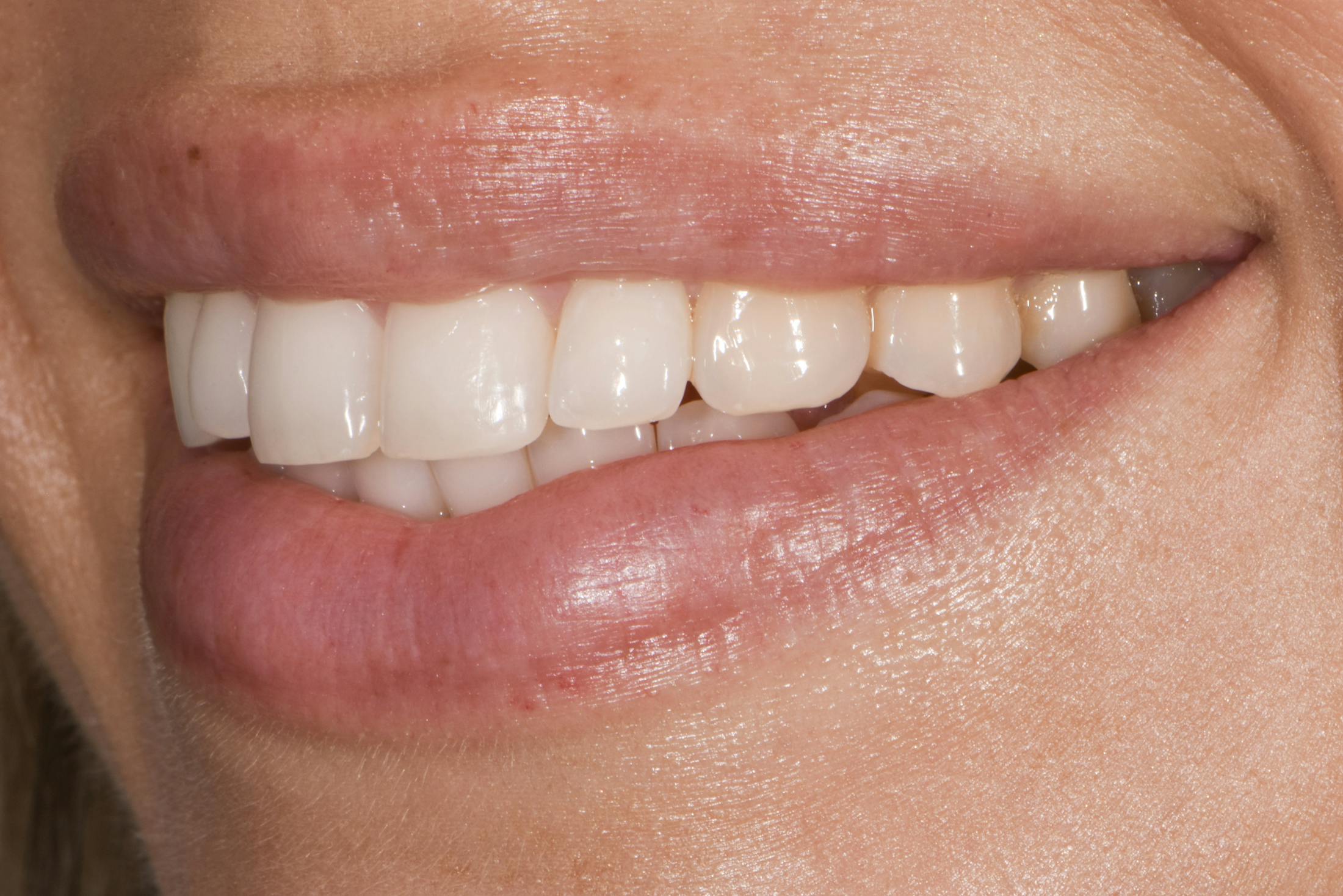Prep-less Veneers Before & After Gallery - Patient 250395 - Image 5