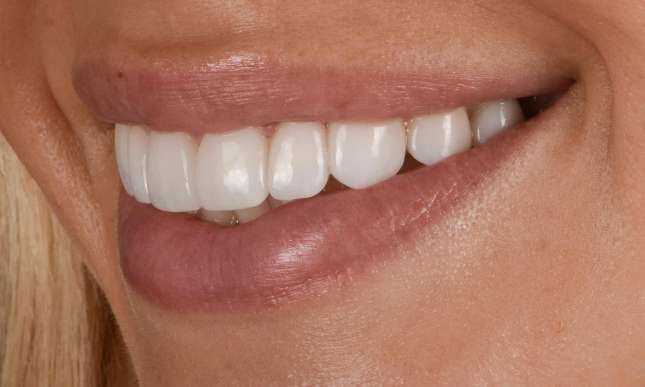 Prep-less Veneers Before & After Gallery - Patient 250395 - Image 6