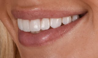 Prep-less Veneers Before & After Gallery - Patient 250395 - Image 6
