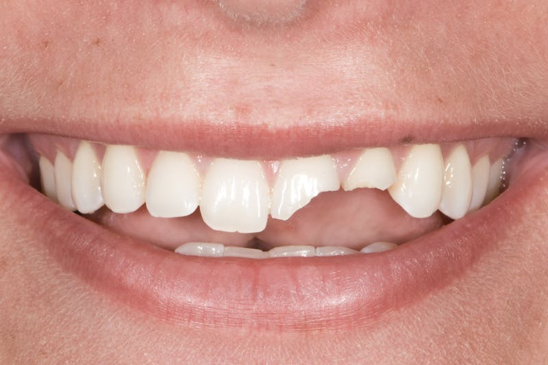 Porcelain Crowns Before & After Gallery - Patient 408881 - Image 1