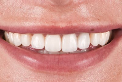 Porcelain Crowns Before & After Gallery - Patient 408881 - Image 2