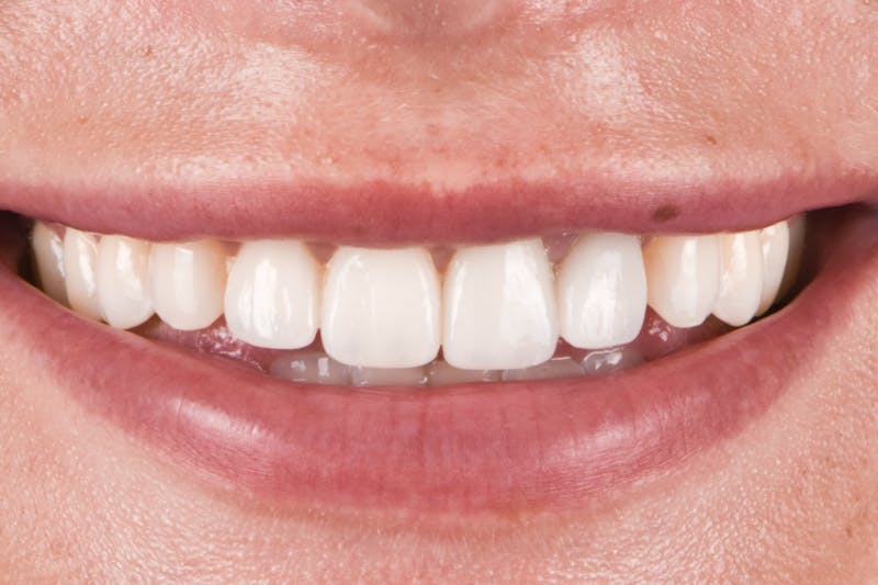 Porcelain Crowns Before & After Gallery - Patient 408881 - Image 2