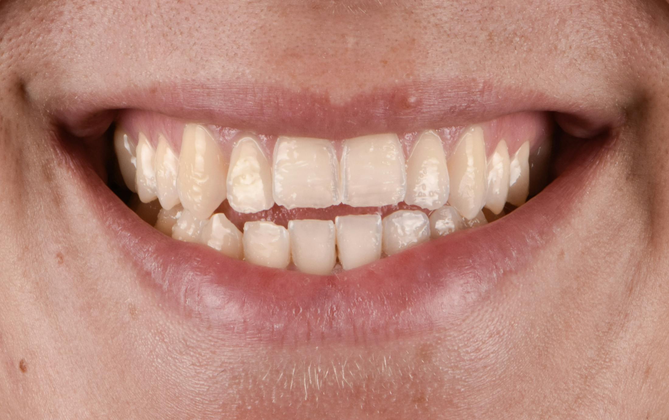 Porcelain Veneers Before & After Gallery - Patient 243629 - Image 1