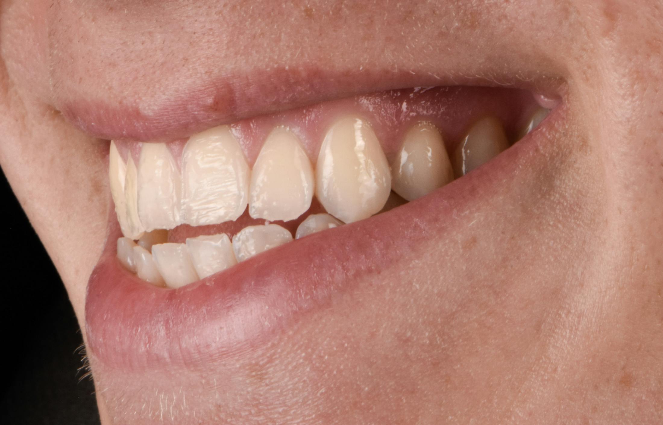 Porcelain Veneers Before & After Gallery - Patient 243629 - Image 3