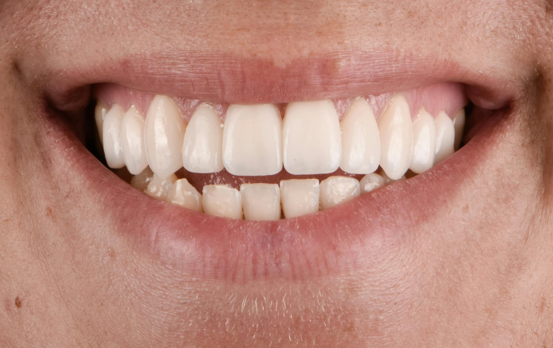 Porcelain Veneers Before & After Gallery - Patient 243629 - Image 2