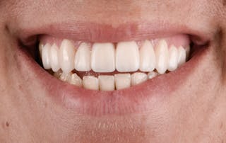 Porcelain Veneers Before & After Gallery - Patient 243629 - Image 2