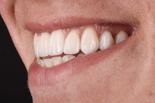 Porcelain Veneers Before & After Gallery - Patient 243629 - Image 4