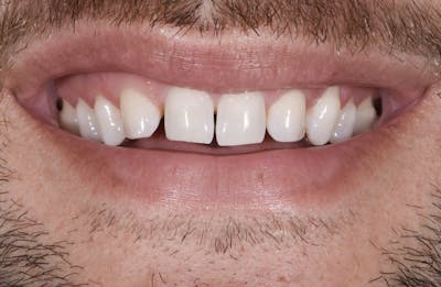 Porcelain Veneers Before & After Gallery - Patient 849284 - Image 1