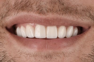 Porcelain Veneers Before & After Gallery - Patient 849284 - Image 2