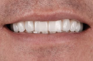Porcelain Veneers Before & After Gallery - Patient 170439 - Image 2