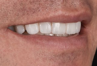 Porcelain Veneers Before & After Gallery - Patient 170439 - Image 4