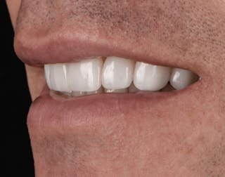 Porcelain Veneers Before & After Gallery - Patient 170439 - Image 6