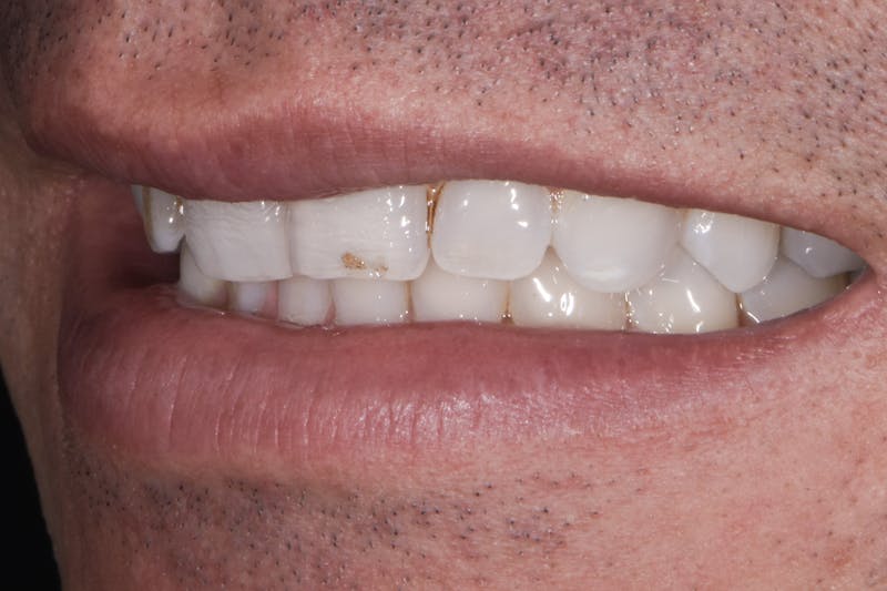 Porcelain Veneers Before & After Gallery - Patient 170439 - Image 5