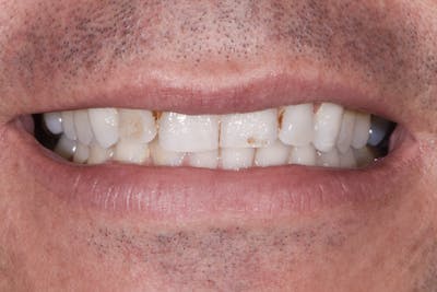 Porcelain Veneers Before & After Gallery - Patient 170439 - Image 1