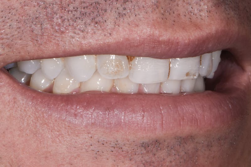 Porcelain Veneers Before & After Gallery - Patient 170439 - Image 3
