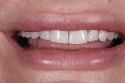 Prep-less Veneers Before & After Gallery - Patient 394092 - Image 1