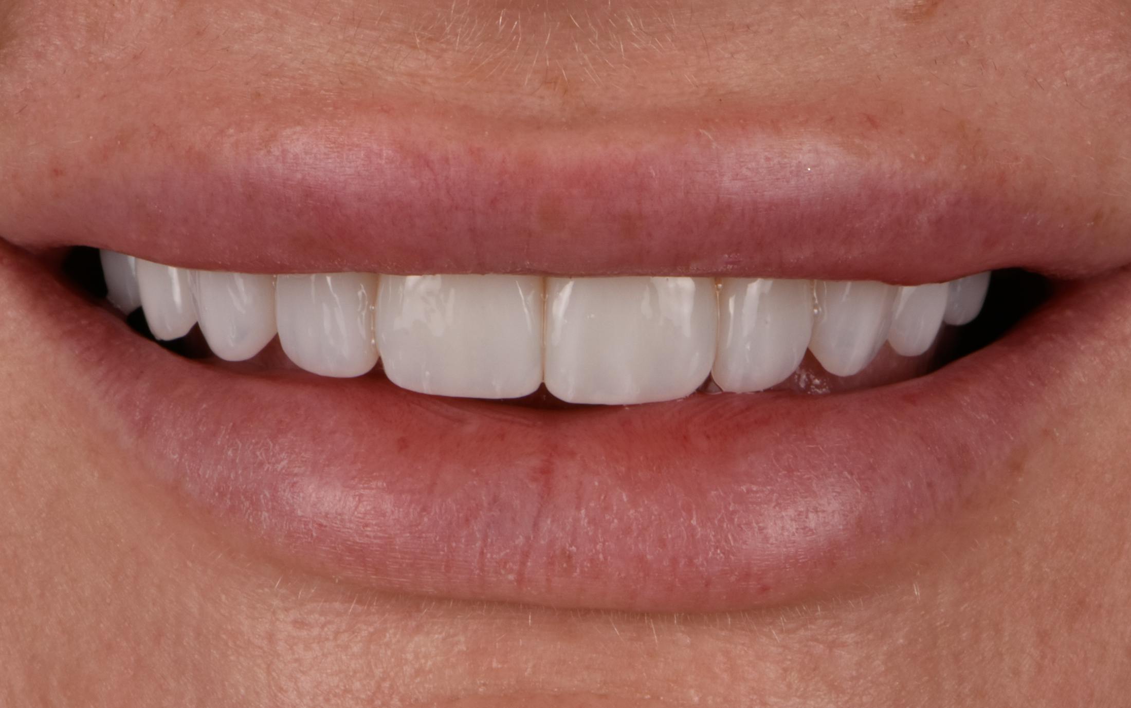 procedure after
