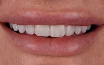 Prep-less Veneers Before & After Gallery - Patient 394092 - Image 2