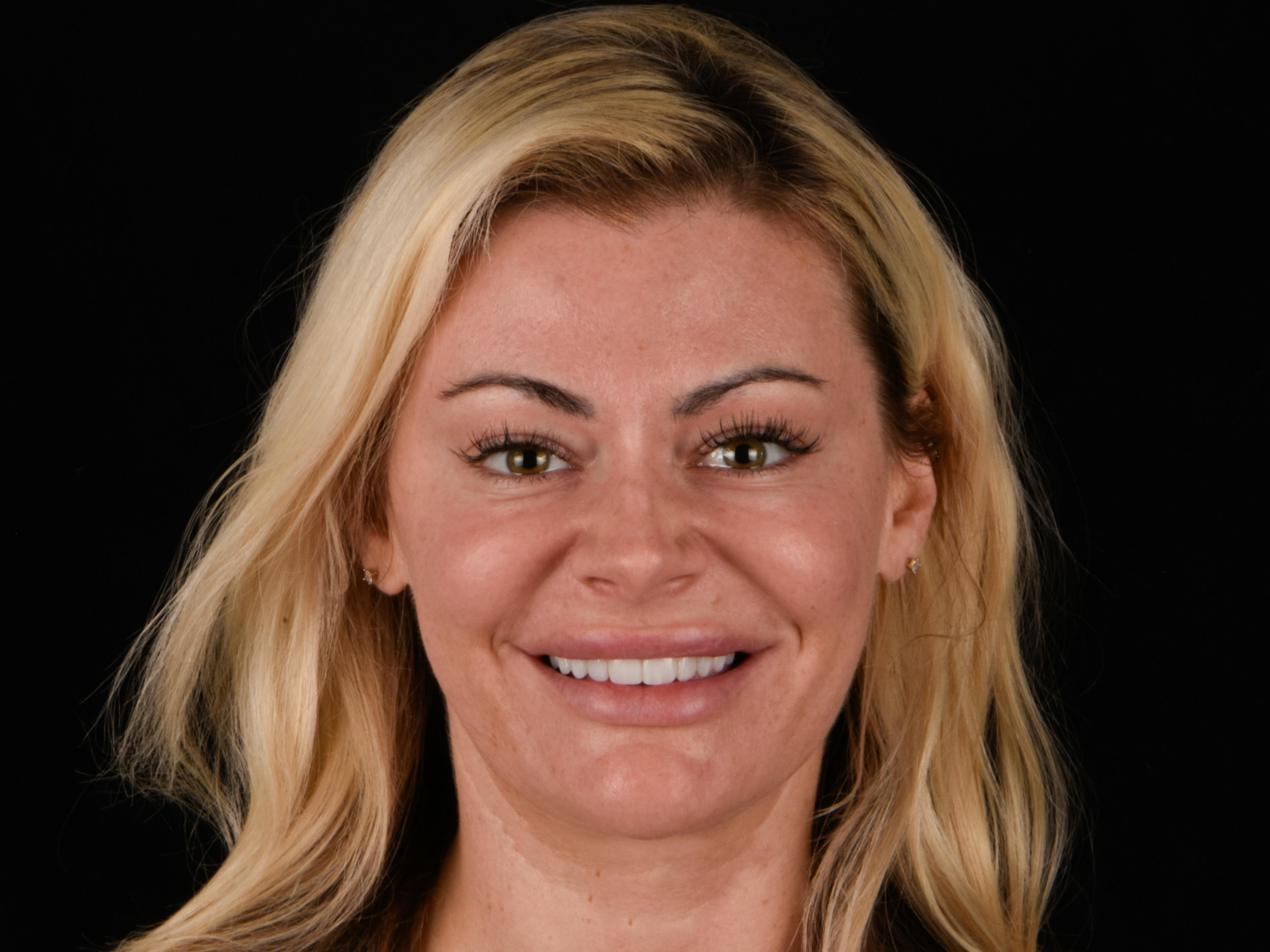 Prep-less Veneers Before & After Gallery - Patient 394092 - Image 1