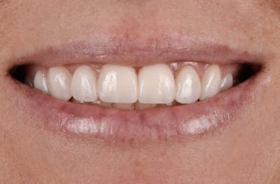 Porcelain Veneers Before & After Gallery - Patient 397569 - Image 2