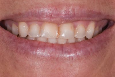 Porcelain Veneers Before & After Gallery - Patient 397569 - Image 1