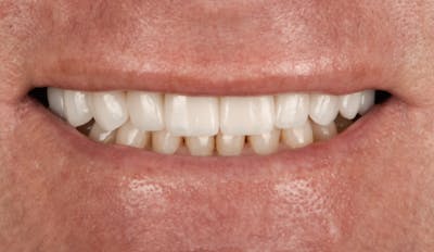 Prep-less Veneers Before & After Gallery - Patient 253421 - Image 2