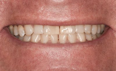 Prep-less Veneers Before & After Gallery - Patient 253421 - Image 1