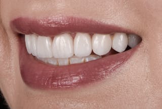 Porcelain Veneers Before & After Gallery - Patient 223835 - Image 6
