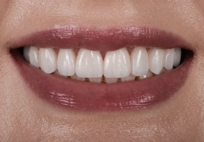 Porcelain Veneers Before & After Gallery - Patient 223835 - Image 2