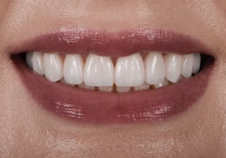 Porcelain Veneers Before & After Gallery - Patient 223835 - Image 2