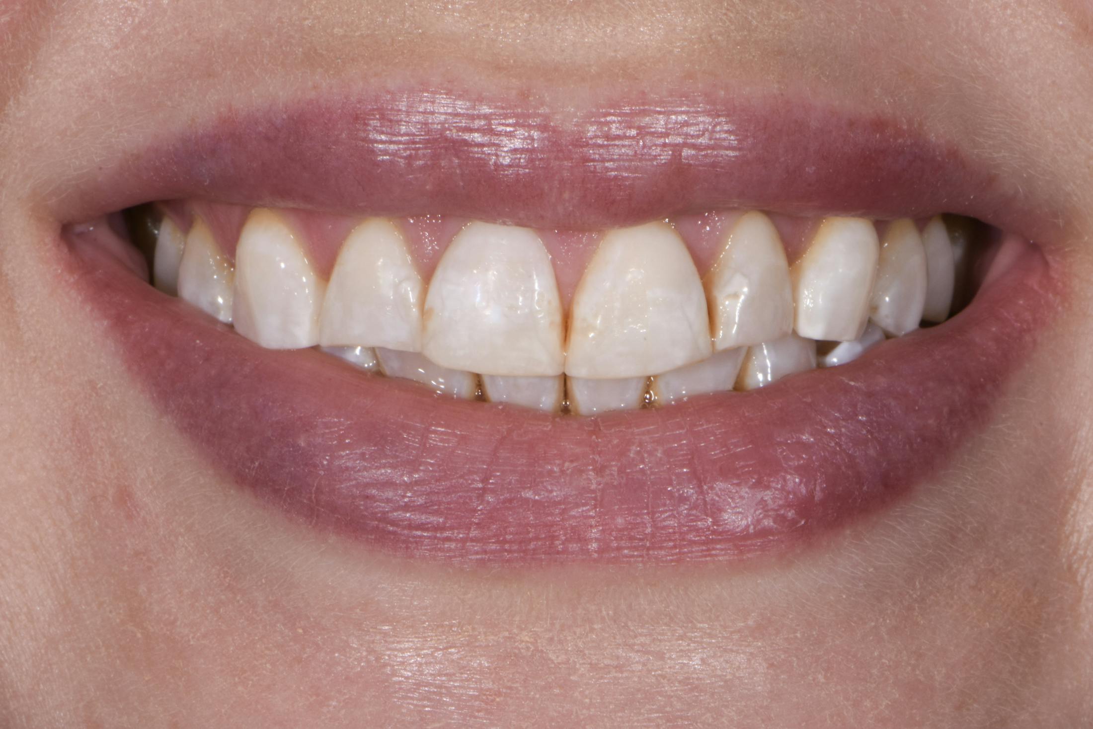 Porcelain Veneers Before & After Gallery - Patient 223835 - Image 1