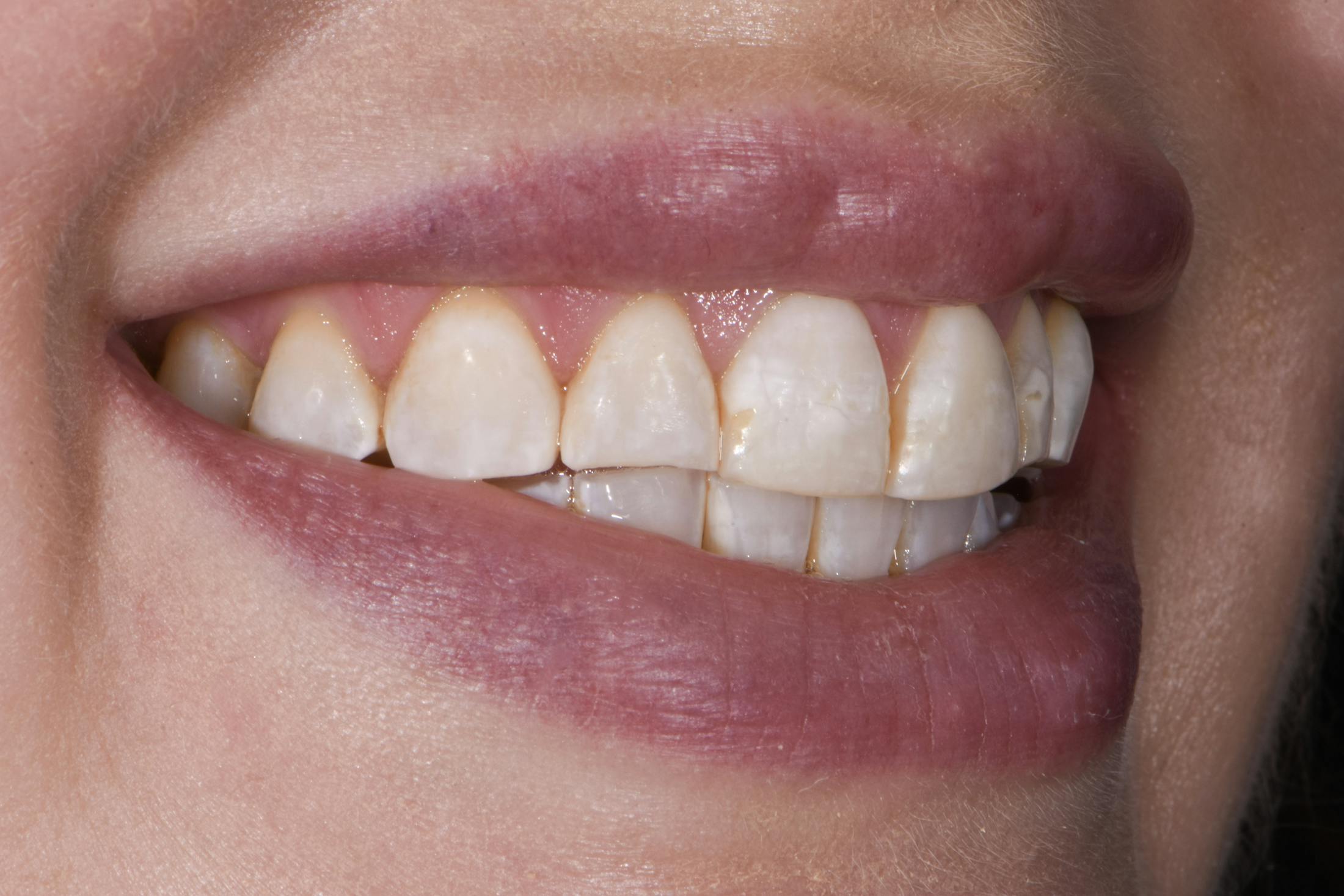Porcelain Veneers Before & After Gallery - Patient 223835 - Image 3