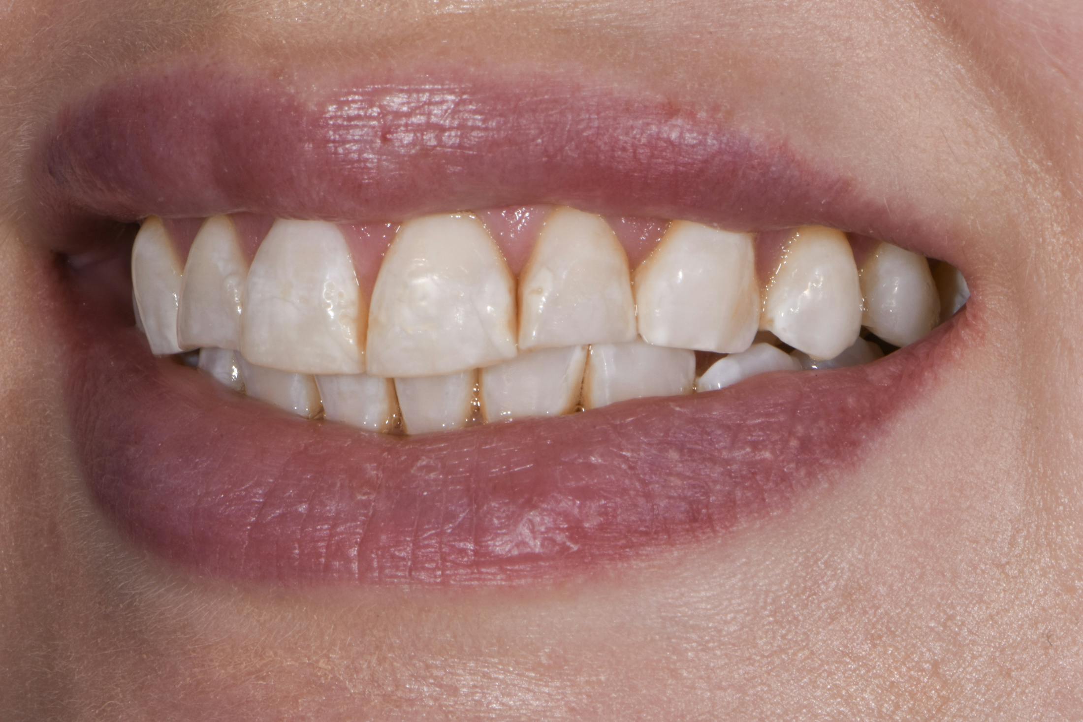 Porcelain Veneers Before & After Gallery - Patient 223835 - Image 5