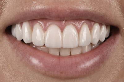 Porcelain Veneers Before & After Gallery - Patient 596270 - Image 2