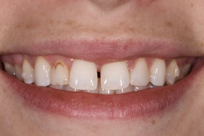 Prep-less Veneers Before & After Gallery - Patient 425121 - Image 1