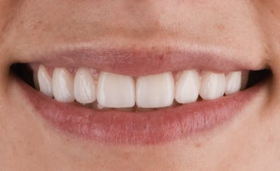 Prep-less Veneers Before & After Gallery - Patient 425121 - Image 2