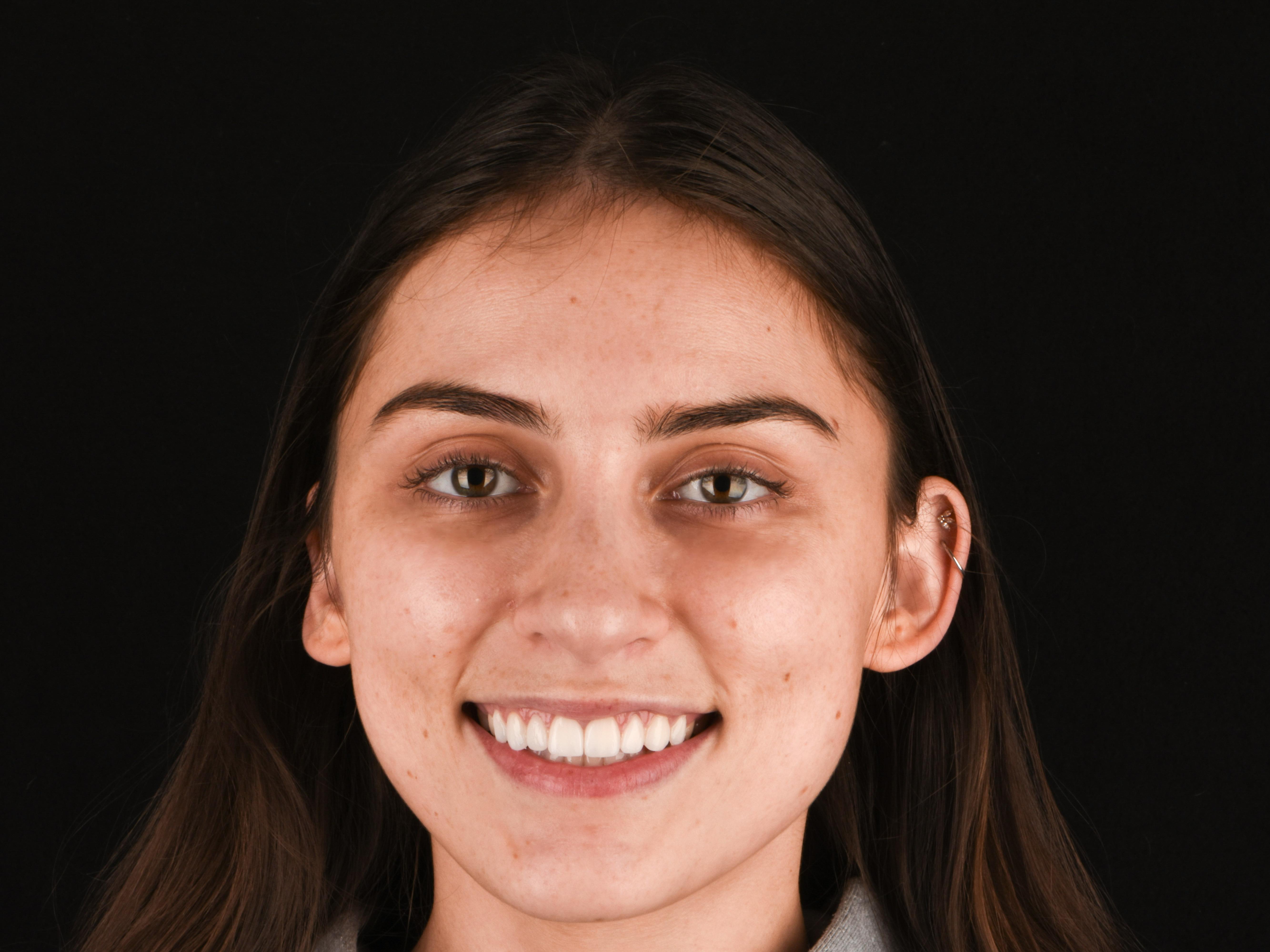 Prep-less Veneers Before & After Gallery - Patient 425121 - Image 1